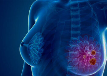 Diretrizes dizem que mais mulheres podem precisar de teste genético para câncer de mama